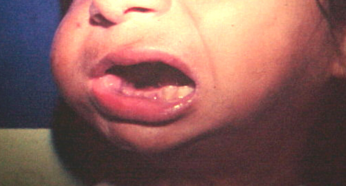 Focused postoperative clinical view showing oral opening 21 days after surgery