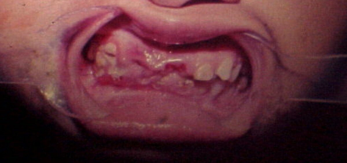 Focused preoperative clinical view showing gingival synechia and severely limited oral opening