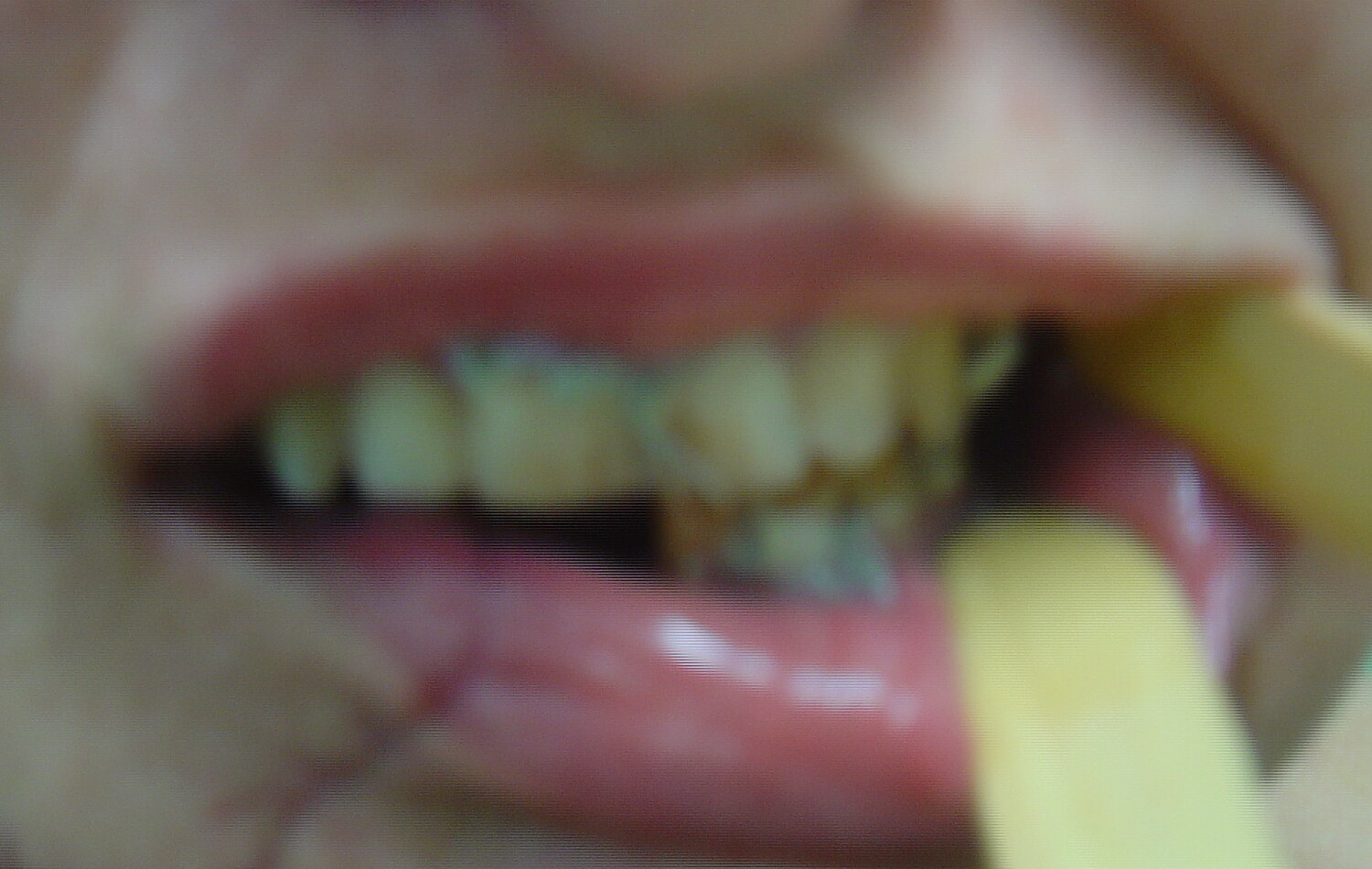 Focused early postoperative clinical image showing the recovered occlusal relationship