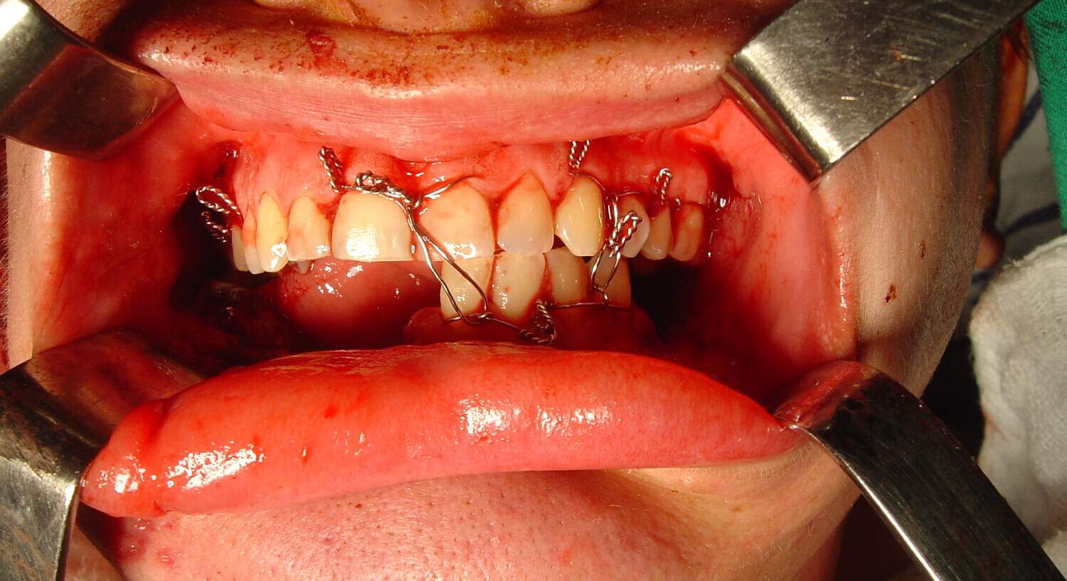 Intraoperative maxillomandibular fixation using the remaining teeth as an occlusal guide