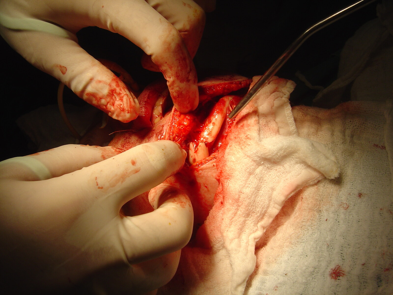 Open reduction of the right mandibular fracture