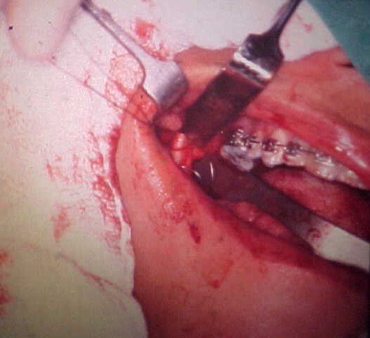 Horizontal osteotomy of the mandibular ramus