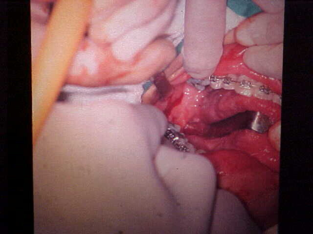 Intraoral surgical access to the mandibular ramus