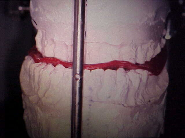 Frontal view of articulated plaster casts after model surgery