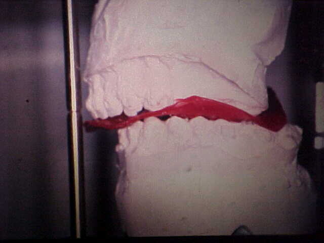 Lateral view of articulated plaster casts after model surgery