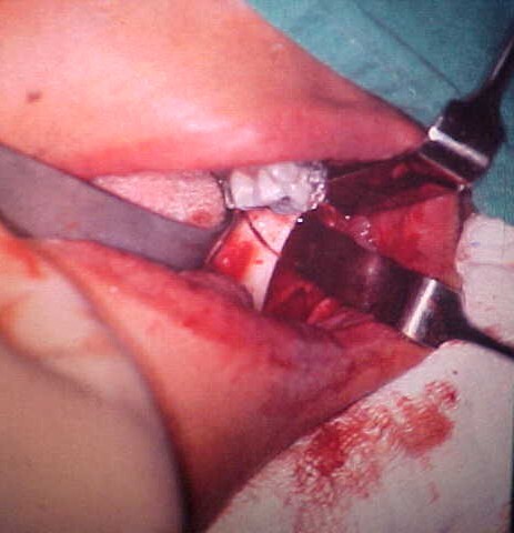 Detailed operative view of the completed ramus osteotomy