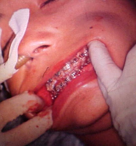 Postoperative intraoral adjustment with orthodontic brackets