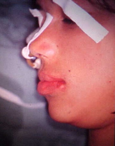 Postoperative lateral facial profile after mandibular repositioning