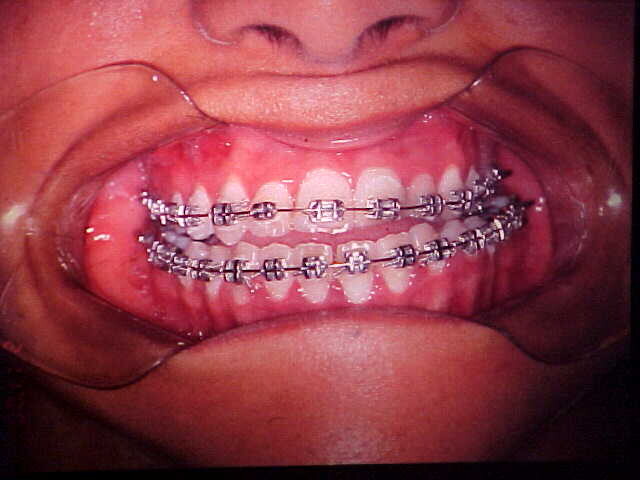 Preoperative frontal intraoral view with orthodontic appliances