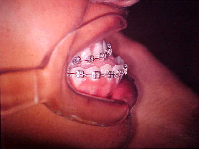 Preoperative lateral intraoral view during orthodontic preparation