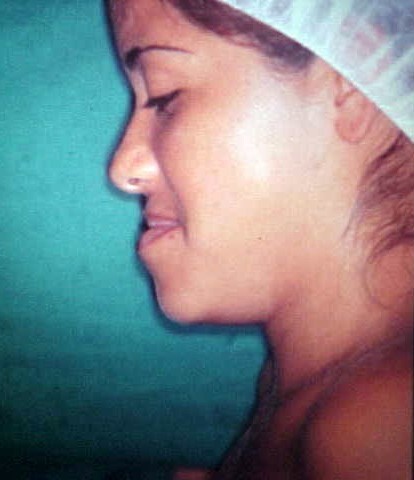 Preoperative lateral facial profile showing severe mandibular prognathism