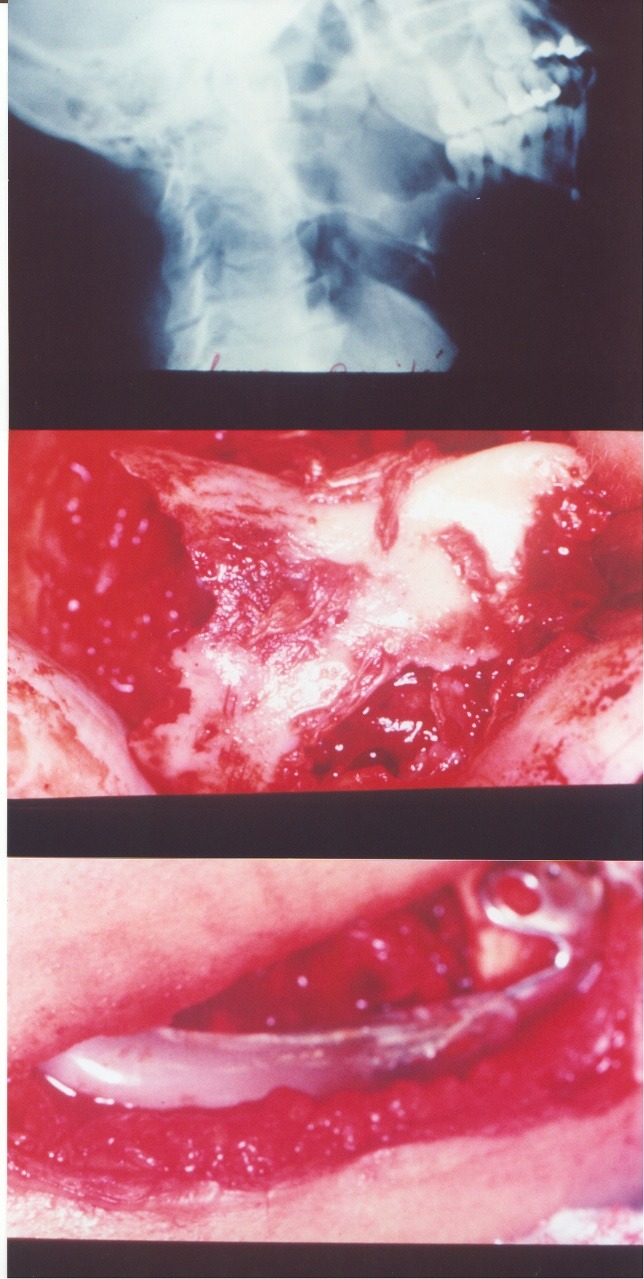 Three-panel historical sequence showing radiographic, operative and intraoral records from the 1975 mandibular tumor case