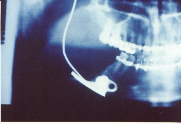 Historical radiograph showing the selected temporary prosthesis spanning the mandibular defect